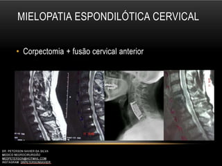 MIELOPATIA ESPONDILÓTICA CERVICAL
• Corpectomia + fusão cervical anterior
 