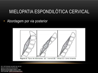 MIELOPATIA ESPONDILÓTICA CERVICAL
• Abordagem por via posterior
 