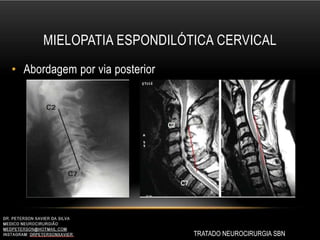 MIELOPATIA ESPONDILÓTICA CERVICAL
TRATADO NEUROCIRURGIA SBN
• Abordagem por via posterior
 