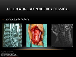 MIELOPATIA ESPONDILÓTICA CERVICAL
• Laminectomia isolada
 