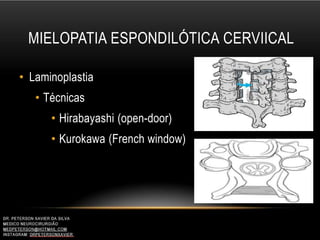 MIELOPATIA ESPONDILÓTICA CERVIICAL
• Laminoplastia
• Técnicas
• Hirabayashi (open-door)
• Kurokawa (French window)
 