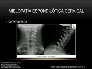 MIELOPATIA ESPONDILÓTICA CERVICAL
• Laminoplastia
British Editorial Society of Bone and Joint 2012
 