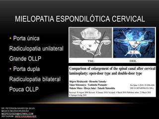 MIELOPATIA ESPONDILÓTICA CERVICAL
• Porta única
Radiculopatia unilateral
Grande OLLP
• Porta dupla
Radiculopatia bilateral
Pouca OLLP
 