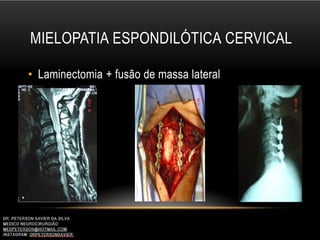 MIELOPATIA ESPONDILÓTICA CERVICAL
• Laminectomia + fusão de massa lateral
 