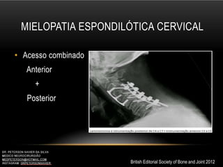 MIELOPATIA ESPONDILÓTICA CERVICAL
• Acesso combinado
Anterior
+
Posterior
British Editorial Society of Bone and Joint 2012
 