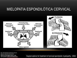 MIELOPATIA ESPONDILÓTICA CERVIICAL
Sugical options for treatment of cervical spondylotic myelopathy. 2002
 