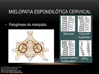 MIELOPATIA ESPONDILÓTICA CERVIICAL
• Patogênese da mielopatia
 