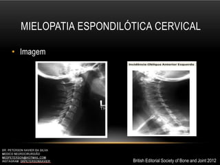 MIELOPATIA ESPONDILÓTICA CERVICAL
• Imagem
British Editorial Society of Bone and Joint 2012
 