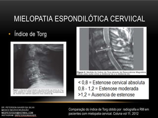MIELOPATIA ESPONDILÓTICA CERVIICAL
• Índice de Torg
Comparação do índice de Torg obtido por radiografia e RM em
pacientes com mielopatia cervical. Coluna vol 11, 2012
 