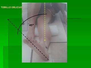 45º
TOBILLO OBLICUO
 