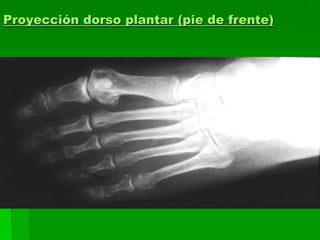Proyección dorso plantar (pie de frente)
 