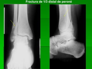 Fractura de 1/3 distal de peroné
 