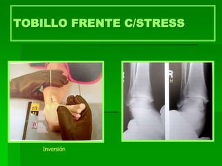 TOBILLO FRENTE C/STRESS
Inversión
 