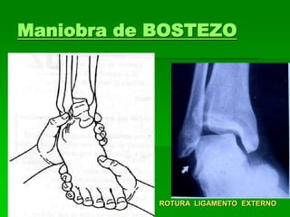 Maniobra de BOSTEZO
ROTURA LIGAMENTO EXTERNO
 