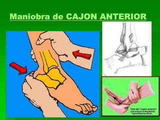 Maniobra de CAJON ANTERIOR
 