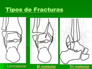 Tipos de Fracturas
Unimaleolar Bi maleolar Tri maleolar
 