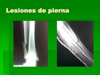 Lesiones de pierna
 