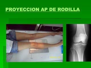 PROYECCION AP DE RODILLA
 