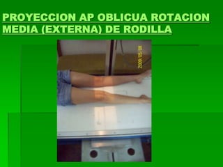 PROYECCION AP OBLICUA ROTACION
MEDIA (EXTERNA) DE RODILLA
 