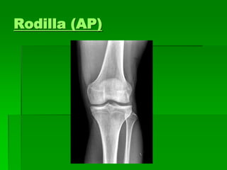 Rodilla (AP)
 