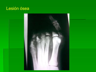 Lesión ósea
 