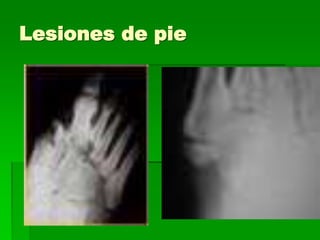 Lesiones de pie
 