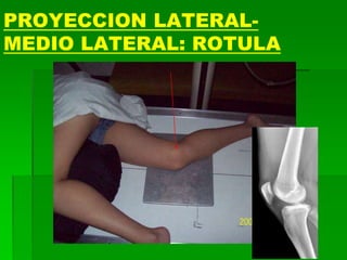 PROYECCION LATERAL-
MEDIO LATERAL: ROTULA
 