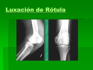 Luxación de Rótula
 