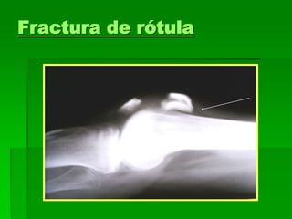 Fractura de rótula
 
