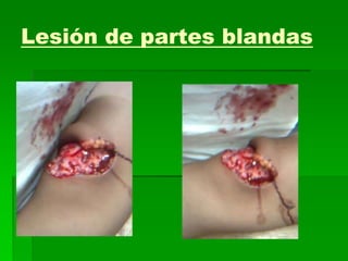 Lesión de partes blandas
 