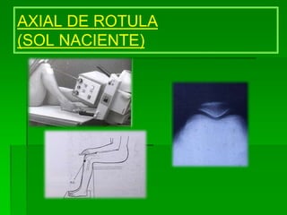 AXIAL DE ROTULA
(SOL NACIENTE)
 