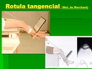 Rotula tangencial (Met. de Merchant)
 