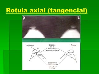Rotula axial (tangencial)
 