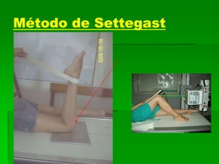 Método de Settegast
 