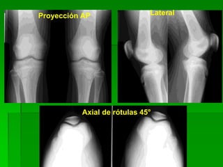 Proyección AP Lateral
Axial de rótulas 45°
 