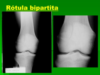 Rótula bipartita
 