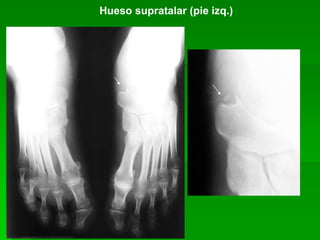Hueso supratalar (pie izq.)
 