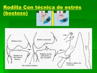 Rodilla Con técnica de estrés
(bostezo)
 