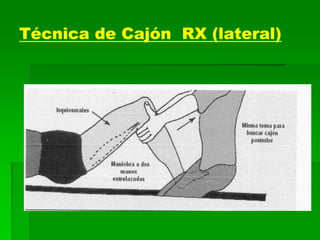 Técnica de Cajón RX (lateral)
 