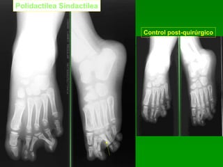 Polidactilea Sindactilea
Control post-quirúrgico
 