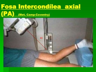 Fosa Intercondílea axial
(PA) (Met. Camp-Coventry)
40
 