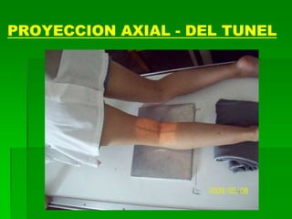 PROYECCION AXIAL - DEL TUNEL
 