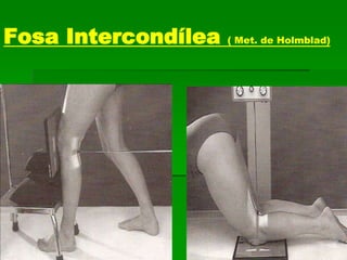 Fosa Intercondílea ( Met. de Holmblad)
 