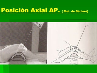 Posición Axial AP. ( Met. de Bécleré)
 