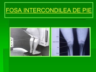 FOSA INTERCONDILEA DE PIE
 