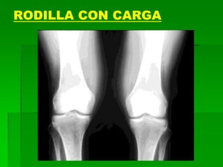 RODILLA CON CARGA
 