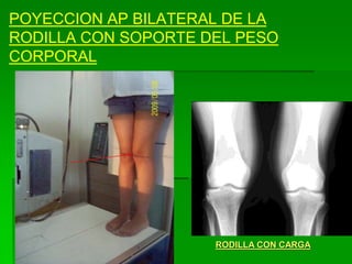 POYECCION AP BILATERAL DE LA
RODILLA CON SOPORTE DEL PESO
CORPORAL
RODILLA CON CARGA
 