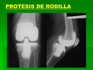 PROTESIS DE RODILLA
 