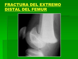 FRACTURA DEL EXTREMO
DISTAL DEL FEMUR
 
