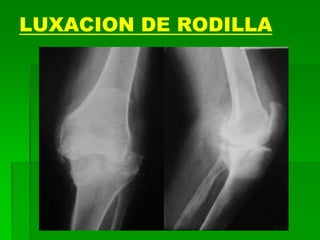 LUXACION DE RODILLA
 